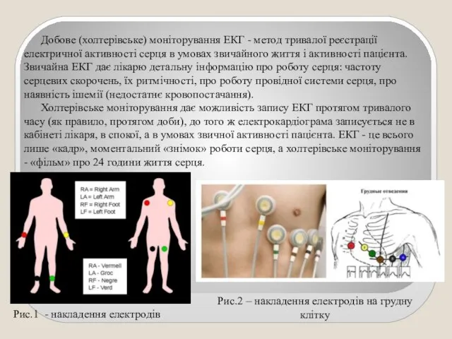 Визначення холтера ЕКГ Рис.1 - накладення електродів Рис.2 – накладення електродів на