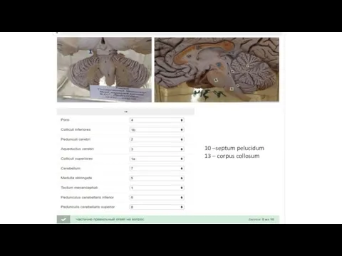 10 –septum pelucidum 13 – corpus collosum