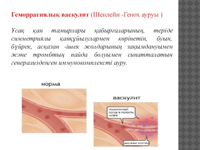 Геморрагиялық васкулит (Шенлейн -Генох ауруы ) Ұсақ қан тамырлары қабырғаларының, теріде симметриялы