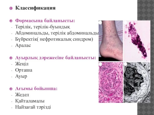 Классификация Формасына байланысты: Терілік, терілік-буындық Абдоминальды, терілік абдоминальды Бүйректік( нефротикалық синдром) Аралас