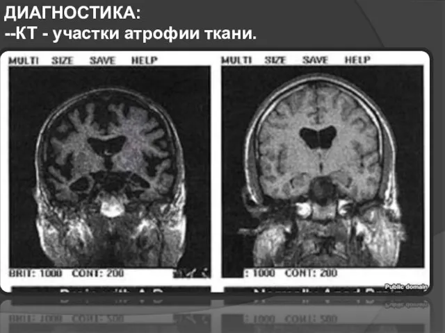 ДИАГНОСТИКА: --КТ - участки атрофии ткани.