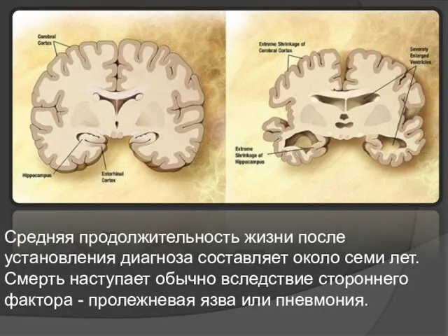 Средняя продолжительность жизни после установления диагноза составляет около семи лет. Смерть наступает