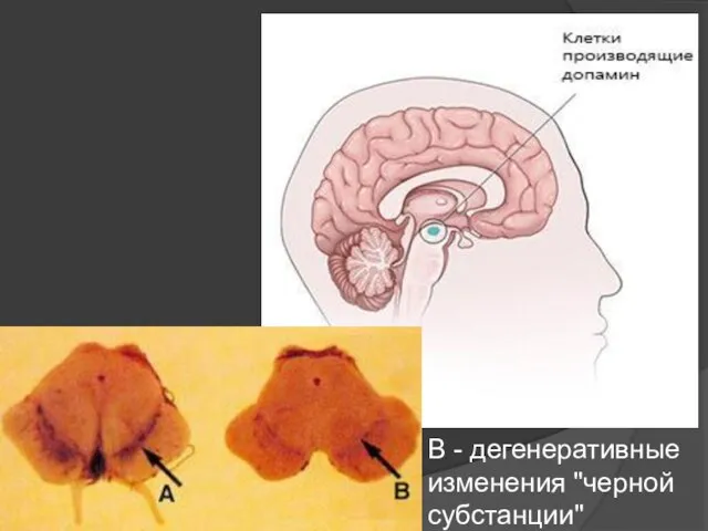 В - дегенеративные изменения "черной субстанции"