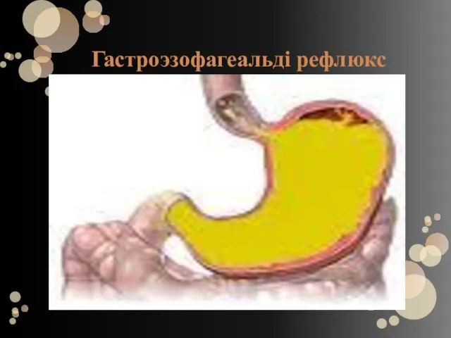 Гастроэзофагеальді рефлюкс