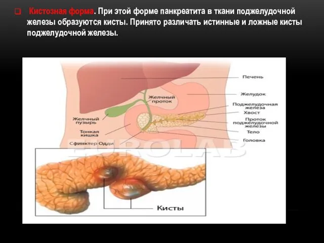 Кистозная форма. При этой форме панкреатита в ткани поджелудочной железы образуются кисты.