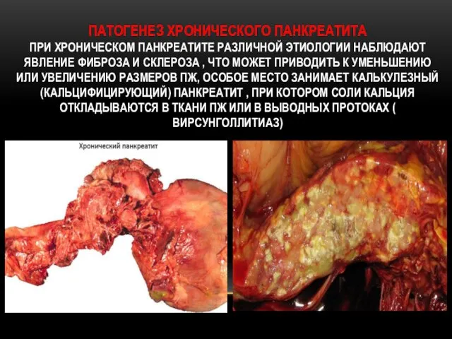 ПАТОГЕНЕЗ ХРОНИЧЕСКОГО ПАНКРЕАТИТА ПРИ ХРОНИЧЕСКОМ ПАНКРЕАТИТЕ РАЗЛИЧНОЙ ЭТИОЛОГИИ НАБЛЮДАЮТ ЯВЛЕНИЕ ФИБРОЗА И