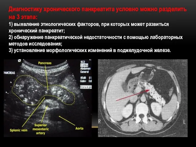 Диагностику хронического панкреатита условно можно разделить на 3 этапа: 1) выявление этиологических