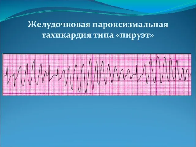 Желудочковая пароксизмальная тахикардия типа «пируэт»