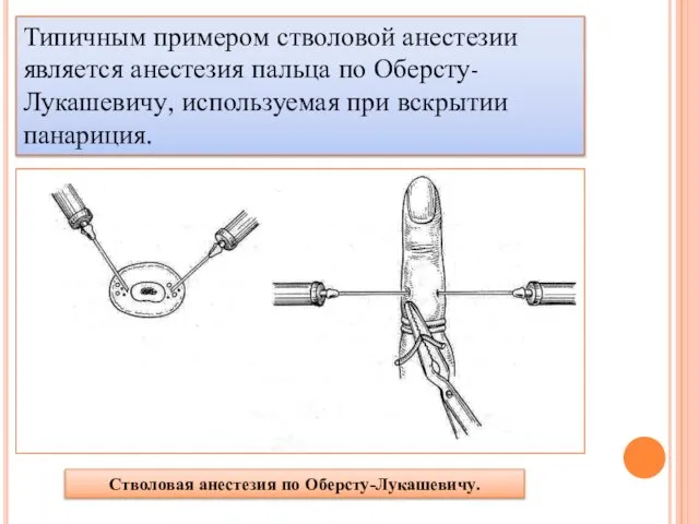 Типичным примером стволовой анестезии является анестезия пальца по Оберсту-Лукашевичу, используемая при вскрытии