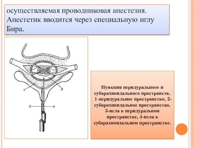 осуществляемая проводниковая анестезия. Анестетик вводится через специальную иглу Бира. Пункция перидурального и