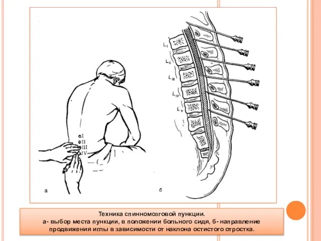 Техника спинномозговой пункции. а- выбор места пункции, в положении больного сидя, б-