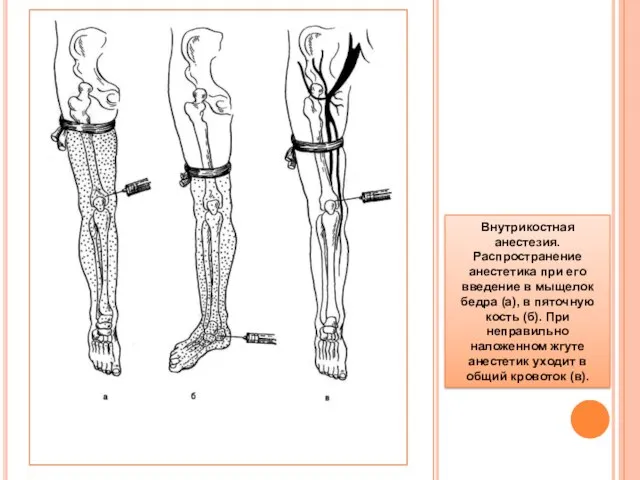 Внутрикостная анестезия. Распространение анестетика при его введение в мыщелок бедра (а), в