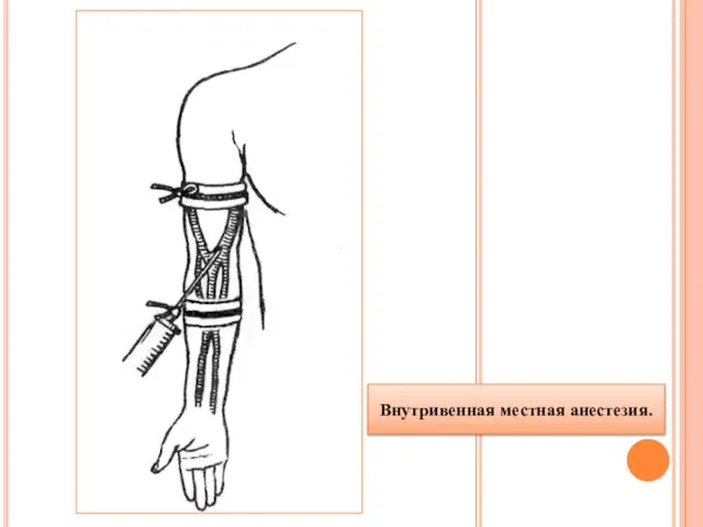 Внутривенная местная анестезия.