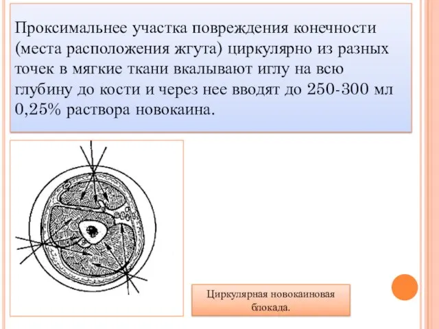 Проксимальнее участка повреждения конечности (места расположения жгута) циркулярно из разных точек в