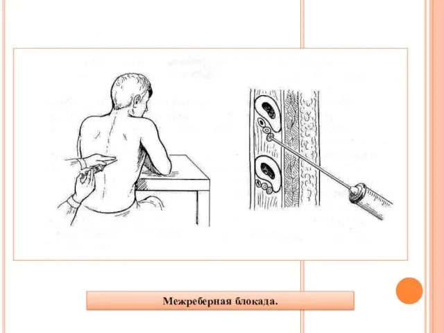 Межреберная блокада.