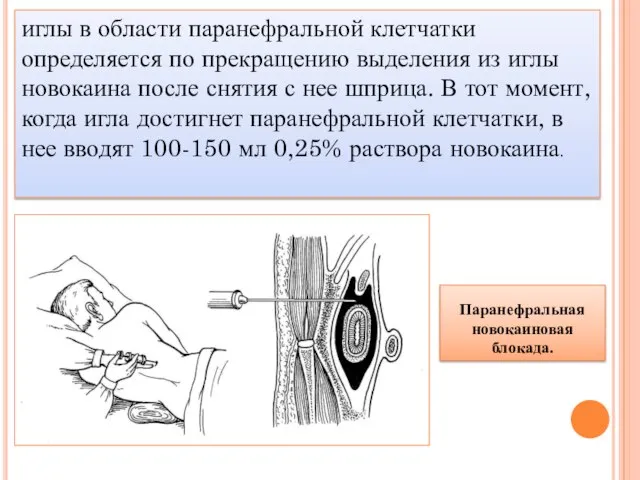 иглы в области паранефральной клетчатки определяется по прекращению выделения из иглы новокаина