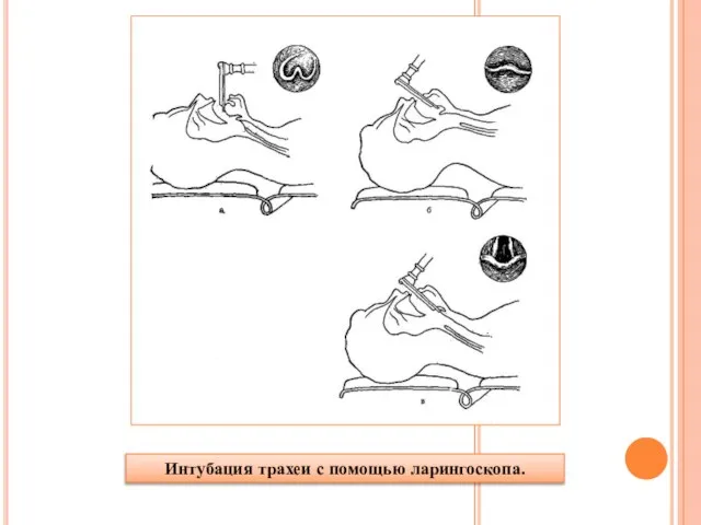 Интубация трахеи с помощью ларингоскопа.