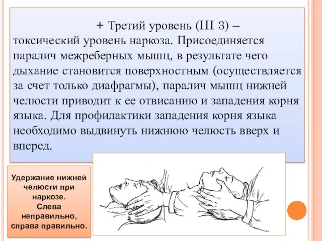 + Третий уровень (III 3) – токсический уровень наркоза. Присоединяется паралич межреберных