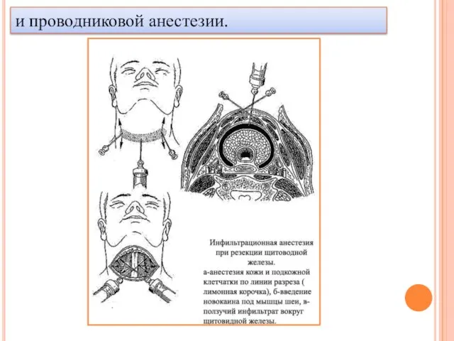 и проводниковой анестезии.