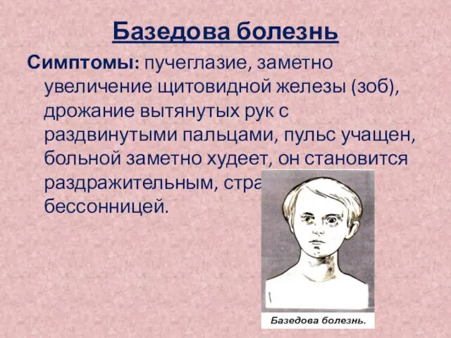 Базедова болезнь Симптомы: пучеглазие, заметно увеличение щитовидной железы (зоб),дрожание вытянутых рук с