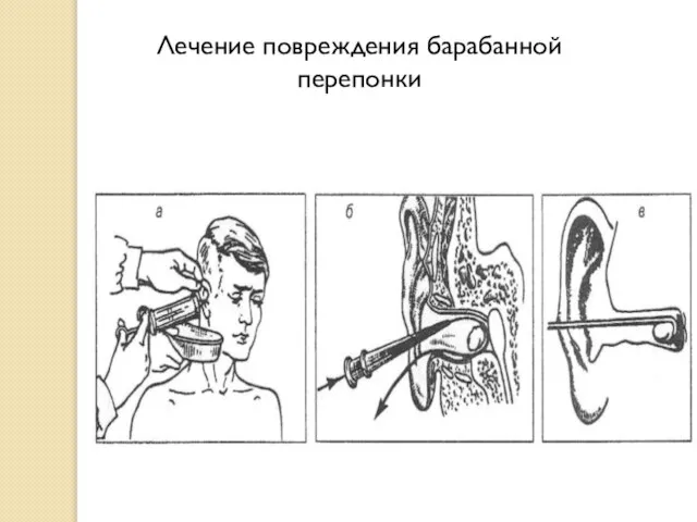 Лечение повреждения барабанной перепонки