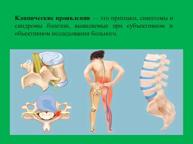 Клинические проявления — это признаки, симптомы и синдромы болезни, выявляемые при субъективном и объективном исследовании больного.