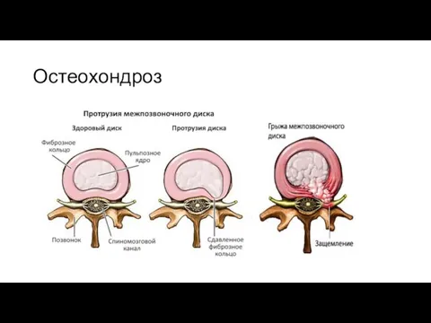 Остеохондроз