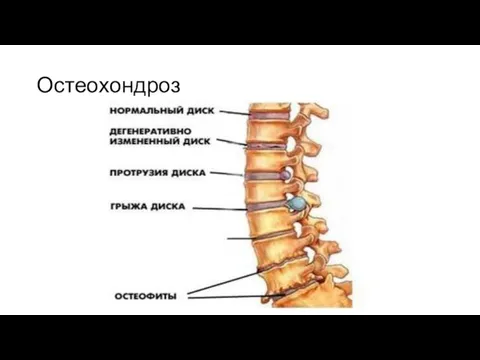 Остеохондроз