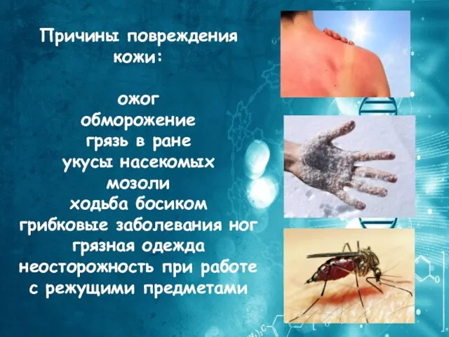 Причины повреждения кожи: ожог обморожение грязь в ране укусы насекомых мозоли ходьба