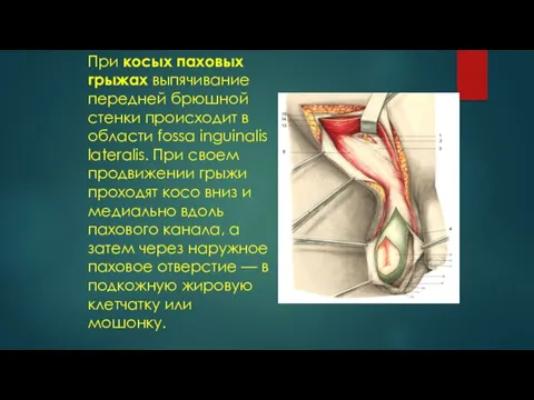 При косых паховых грыжах выпячивание передней брюшной стенки происходит в области fossa