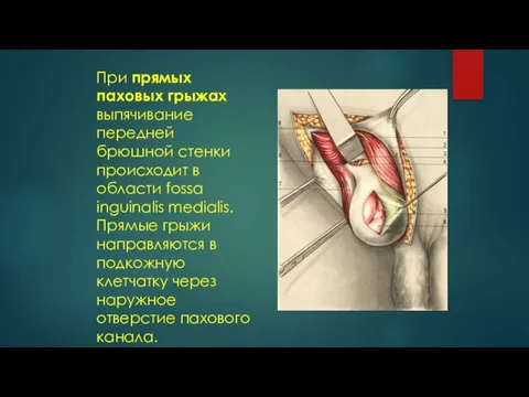 При прямых паховых грыжах выпячивание передней брюшной стенки происходит в области fossa