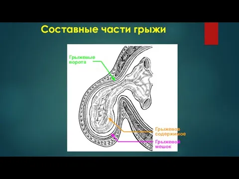 Составные части грыжи Грыжевые ворота Грыжевое содержимое Грыжевой мешок