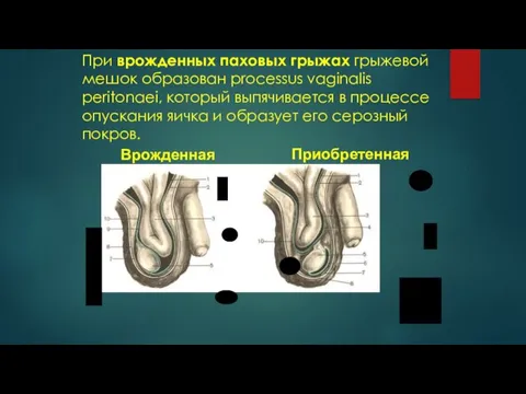 При врожденных паховых грыжах грыжевой мешок образован processus vaginalis peritonaei, который выпячивается