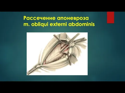 Рассечение апоневроза m. obliqui externi abdominis