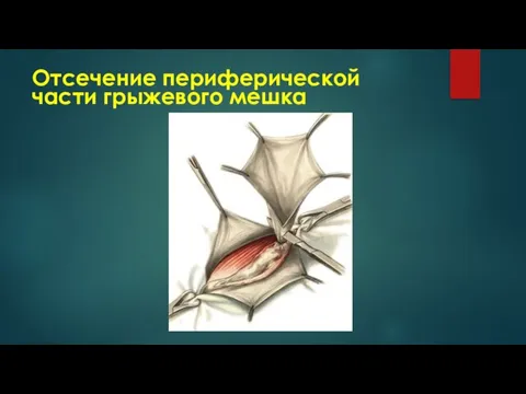 Отсечение периферической части грыжевого мешка