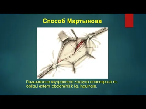 Подшивание внутреннего лоскута апоневроза m. obliqui externi abdominis k lig. inguinale. Способ Мартынова