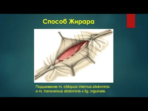 Способ Жирара Подшивание m. obliquus internus abdominis и m. transversus abdominis к lig. inguinale.