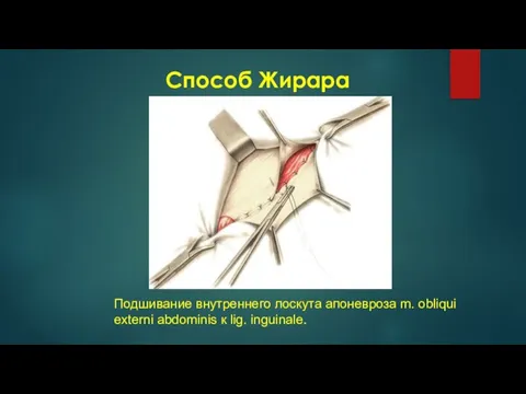 Способ Жирара Подшивание внутреннего лоскута апоневроза m. obliqui externi abdominis к lig. inguinale.