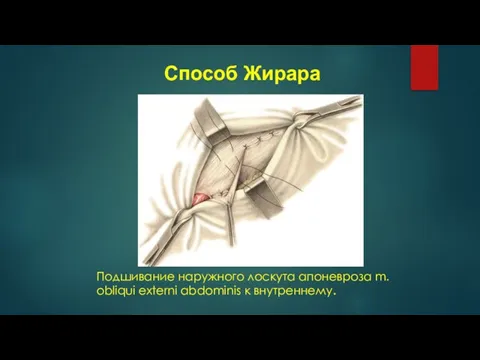 Подшивание наружного лоскута апоневроза m. obliqui externi abdominis к внутреннему. Способ Жирара