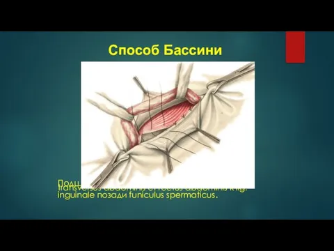 Подшивание mm. obliquus internus abdominis, transversus abdominis et rectus abdominis к lig.