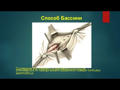 Сшивание внутреннего и наружного лоскутов апоневроза m. obliqui externi abdominis поверх funiculus spermaticus. Способ Бассини