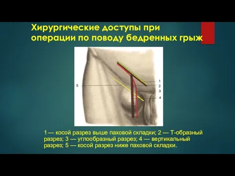 Хирургические доступы при операции по поводу бедренных грыж 1 — косой разрез