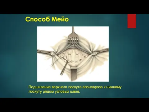 Способ Мейо Подшивание верхнего лоскута апоневроза к нижнему лоскуту рядом узловых швов.