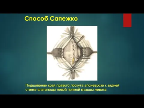 Способ Сапежко Подшивание края правого лоскута апоневроза к задней стенке влагалища левой прямой мышцы живота.