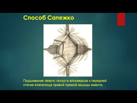 Способ Сапежко Подшивание левого лоскута апоневроза к передней стенке влагалища правой прямой мышцы живота.