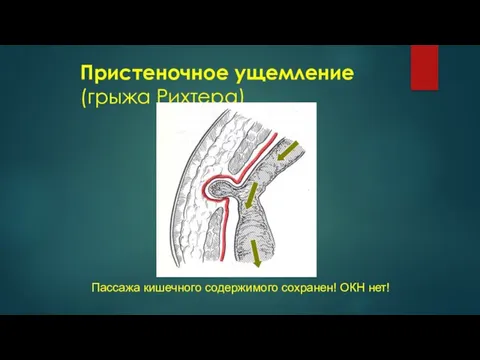 Пристеночное ущемление (грыжа Рихтера) Пассажа кишечного содержимого сохранен! ОКН нет!