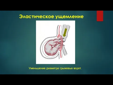 Эластическое ущемление Уменьшение диаметра грыжевых ворот.