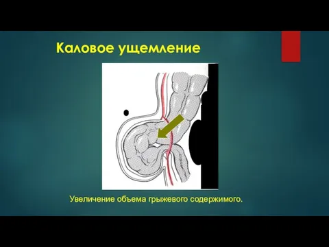 Каловое ущемление Увеличение объема грыжевого содержимого.