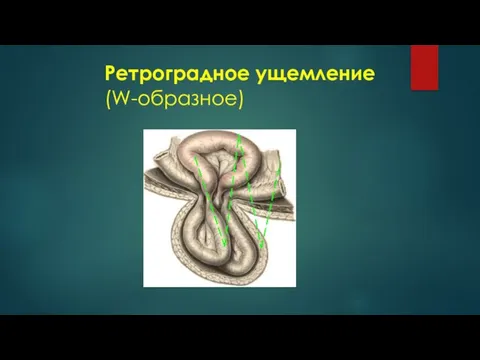 Ретроградное ущемление (W-образное)