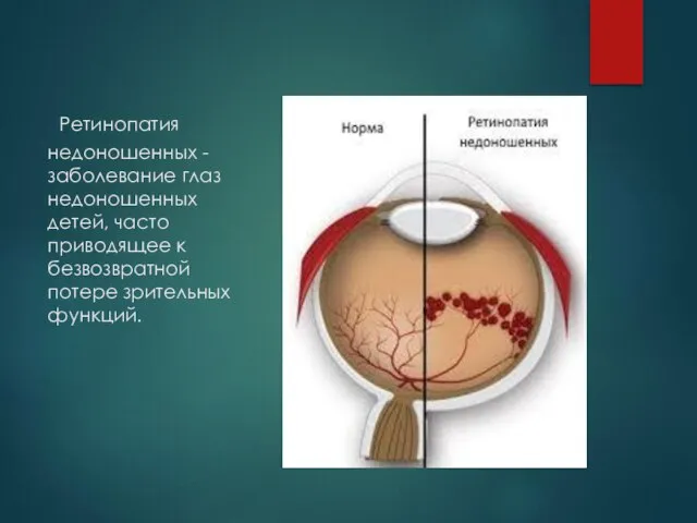 Ретинопатия недоношенных - заболевание глаз недоношенных детей, часто приводящее к безвозвратной потере зрительных функций.